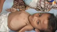 [VIDEO] Uki Bocah 9 Tahun Alami Gizi Buruk, Bobot Cuma 11 Kg