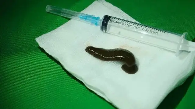 Lintah Penghisap Darah Menempel di Tenggorokan, Suara Pria Ini Jadi Serak