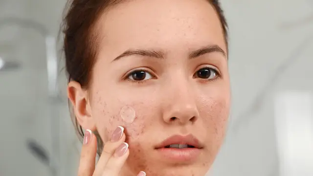 Mau Menggunakan Makeup Saat Wajah Jerawatan? Begini Triknya Biar Kondisinya Nggak Semakin Meradang