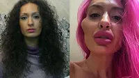 Lakukan Filler Pipi Sendiri, Wajah Wanita Ini Berubah Jadi Aneh