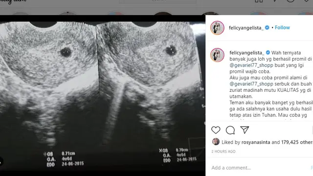 Felicya Angelista pamer foto hasil USG dua hari usai menikah dengan Caesar Hito (https://www.instagram.com/p/CJ5BC4enJ3z/)
