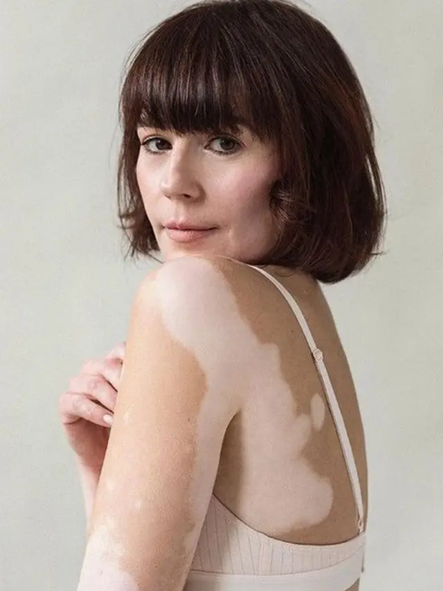 model vitiligo