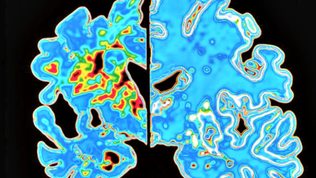 Hebat, 'Virtual Reality' Bisa Prediksi penyakit Alzheimer's 