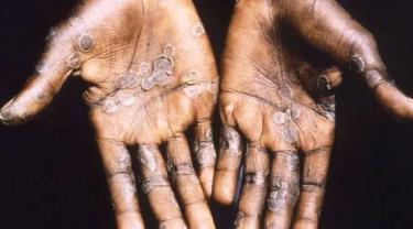 Monkeypox, infeksi virus langka mirip dengan cacar (Photo: CDC Public Health Image Library)