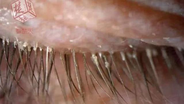 Ratusan Tungau Bersarang di Bulu Mata Wanita Ini, Akibatnya...