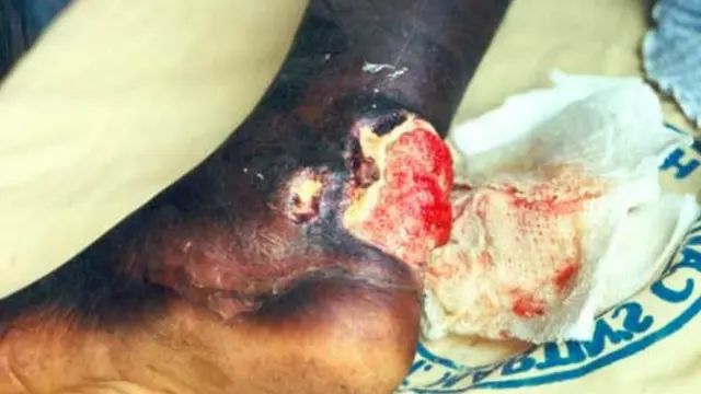 Kaki yang terinfeksi Mycobacterium ulcerans (CDC)
