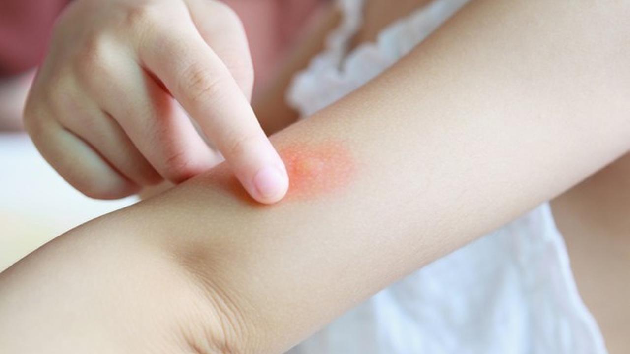 Gambar Ilustrasi Sengatan Nyamuk Demam Berdarah