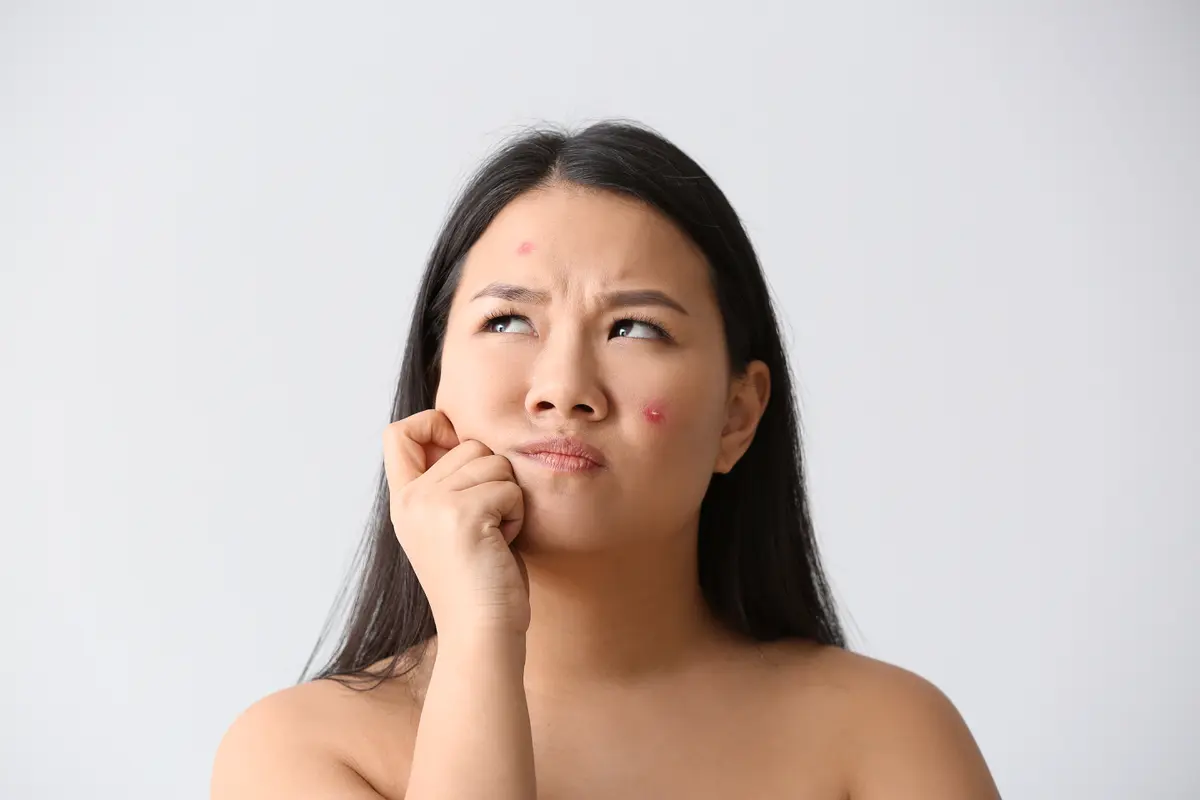 ilustrasi jerawat batu/shutterstock