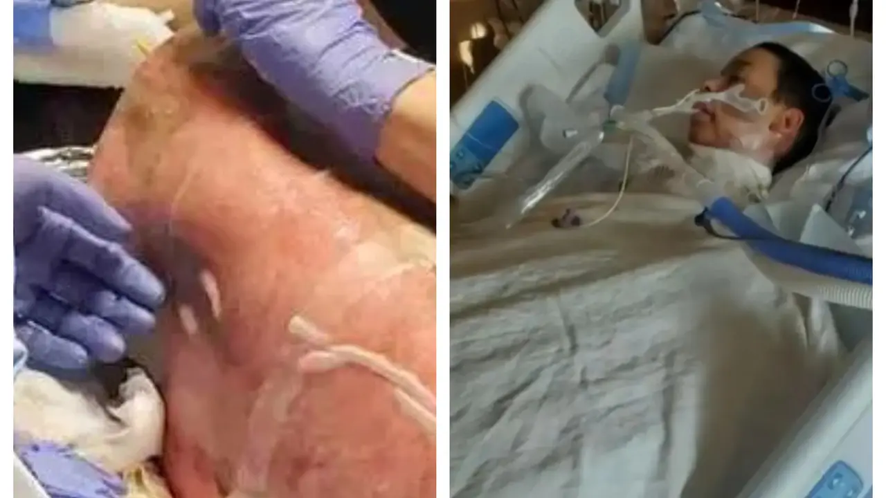 Ikut Challenge di TikTok, Remaja Ini Menderita Luka Bakar di Sekujur Tubuhnya