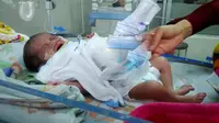 Bayi Arumi Adiba Nasha Razeta terlahir dengan kelainan dinding perut atau Gastrochisis. (Foto: Liputan6.com/Dok. Keluarga/Muhamad Ridlo)