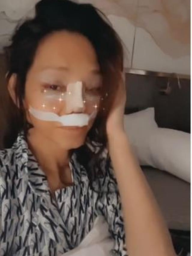 Bunda Corla Operasi Plastik, Ini 6 Potretnya dengan Perban dan Wajah Lebam