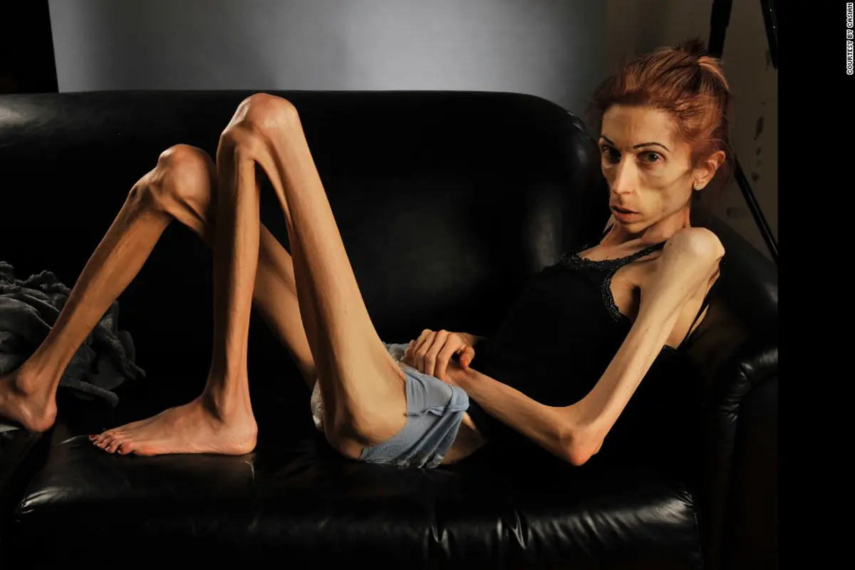 Cantiknya Rachael Farrokh Sebelum Mengalami Anorexia
