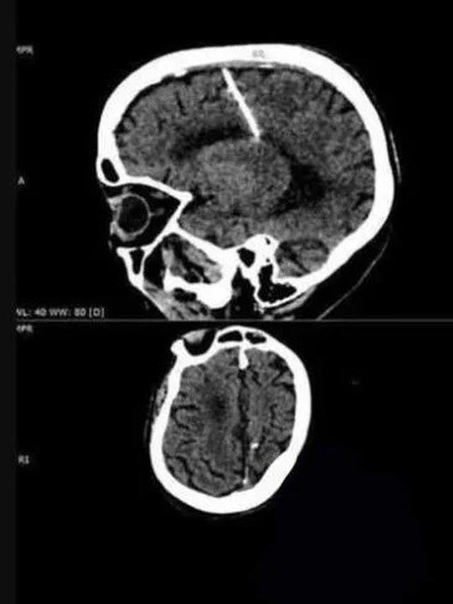 Jarum Tertancap di Otak