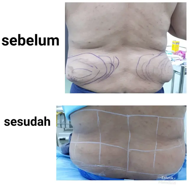 Pengalaman Menjalani Liposuction, Ternyata Nggak Menakutkan Seperti yang Banyak Beredar