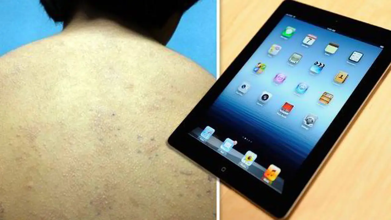 iPad Terbukti Picu Alergi Kulit Pada Anak