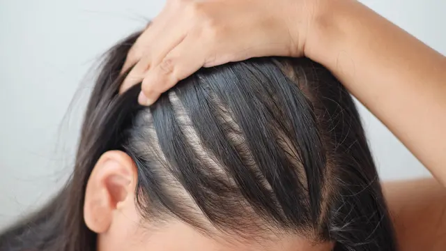 Ciri-ciri Rambut Rontok Berlebihan yang Wajib Diwaspadai, Segera Temukan Perawatan yang Tepat!