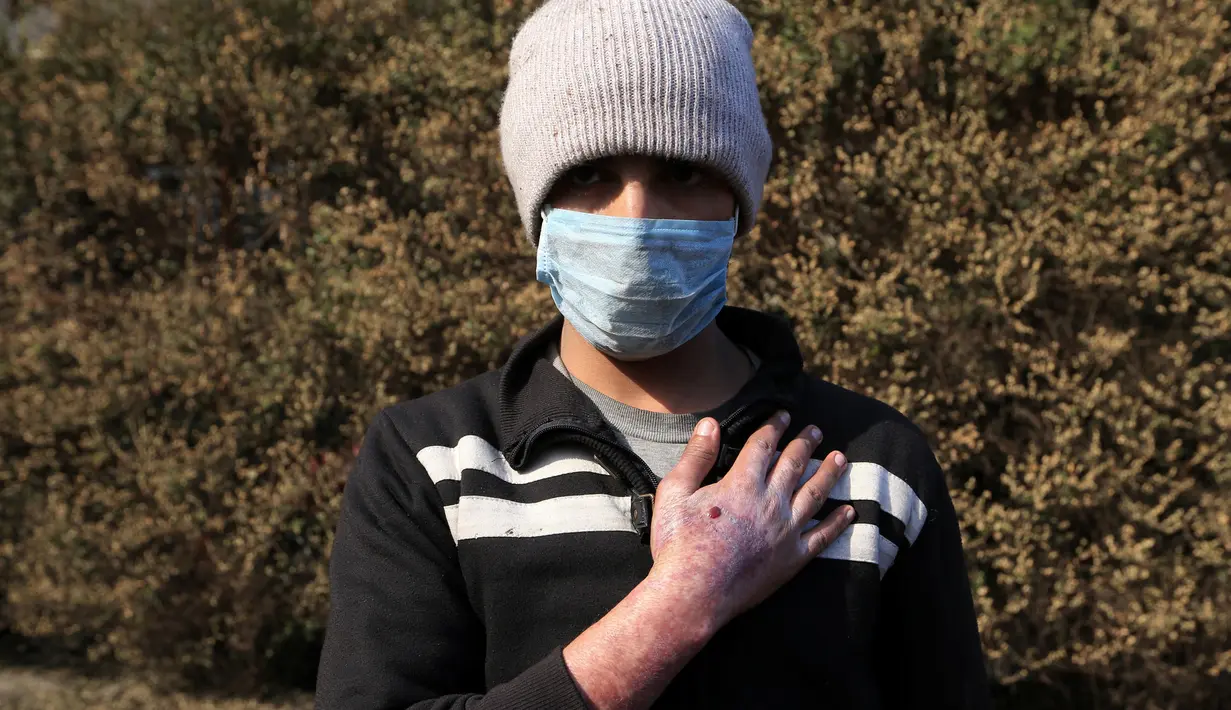 Sirhan Awwad menunjukkan kondisi tanganya setelah terkena dampak bom kimia yang dilancarkan oleh militan ISIS di Qayyara, Irak (12/11). Militan ISIS dilaporkan telah melakukan aksi membakar pabrik kimia. (REUTERS/Air Jalal)
