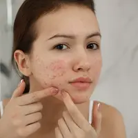 ilustrasi efek samping salicylic acid untuk kulit jerawat/New Africa/shutterstock