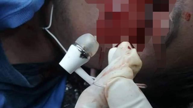 Tragis, Remaja Tewas karena Pakai Earphone saat Ponsel Dicas