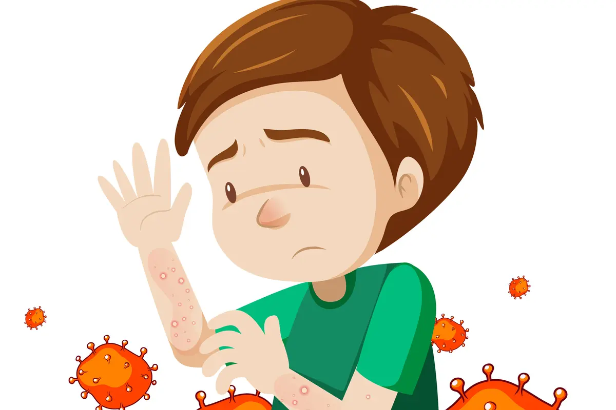 Ilustrasi Monkeypox atau cacar monyet (brgfx/Freepik)