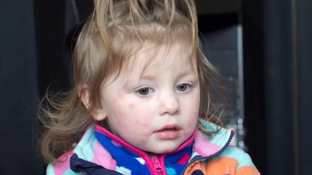 Cara Mengatasi Ruam Merah pada Kulit Anak