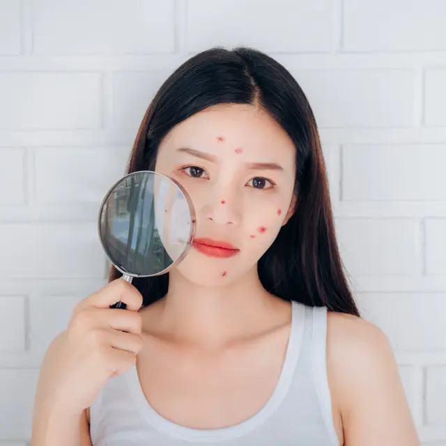 Kandungan Skincare Untuk Menyembuhkan Jerawat Pustula Beauty Fimela Com