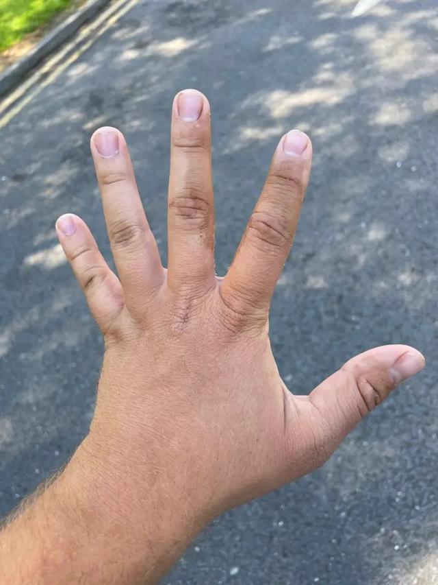 Bahaya Getah Jambu Monyet