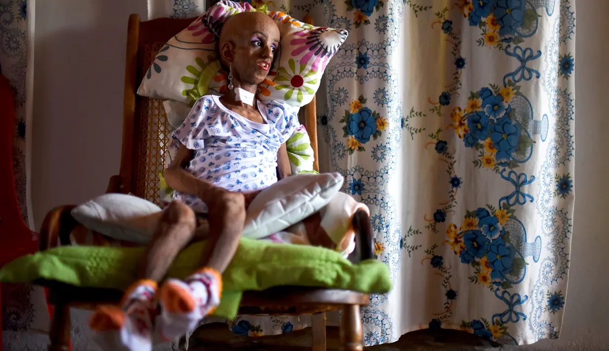 Magali Gonzalez Sierra bersiap merayakan ulang tahunnya ke-15 di El Cabuyal, Kolombia, 16 Januari 2016. Magali menderita progeria, kelainan genetik yang membuat tubuhnya cepat tua sehingga memiliki tubuh setara wanita berusia 90 tahun. (AFP/LUIS ROBAYO)