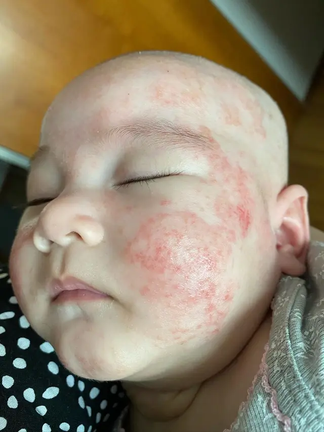 7 Potret Perjuangan Mona Ratuliu Rawat Anak yang Idap Dermatitis Atopik
