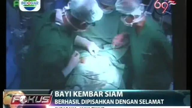 Bayi Kembar Siam, Berhasil Dipisahkan dengan Selamat