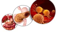 Ilustrasi sel kanker yang tumbuh di pankreas/Shutterstock.
