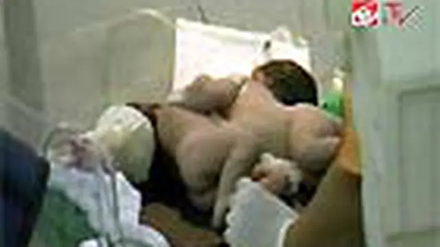 Bayi Lahir Dempet Perut dan Dada