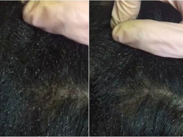 3 Serangan Ganas Kutu Kepala Ini Bisa Bikin Anda Merinding Global Liputan6 Com