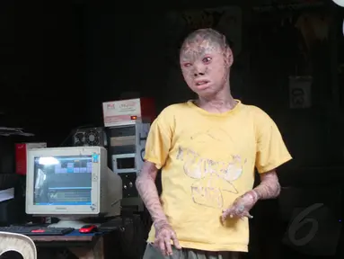 Ari Wibowo, remaja 16 tahun asal Tangerang yang memiliki kelainan kulit. (Liputan6.com/Benedikta Desideria)