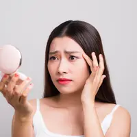 Ilustrasi jerawat/copyright shutterstock