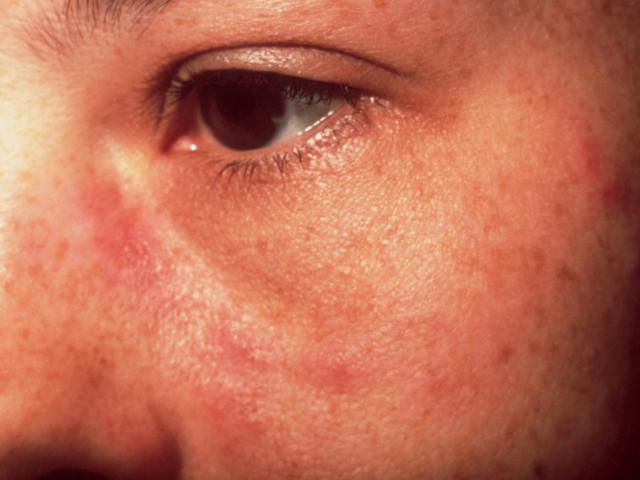 Penyakit Lupus Sle Kenali Gejala Penyebab Dan Cara Pengobatannya Hot Liputan6 Com