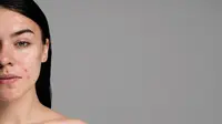 Masalah kesehatan kulit, seperti jerawat juga bisa muncul akibat dari tidur dengan rambut basah. (Sumber: Freepik).