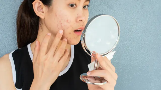 ilustrasi jerawat pustula/Boyloso/shutterstock