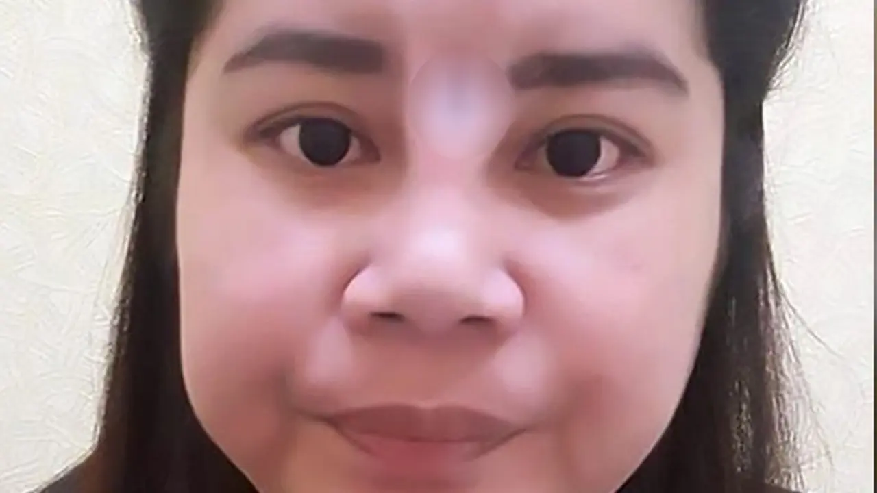 [Bintang] Ingin Mancung, Hidung Wanita Ini Malah Berlubang Usai Operasi