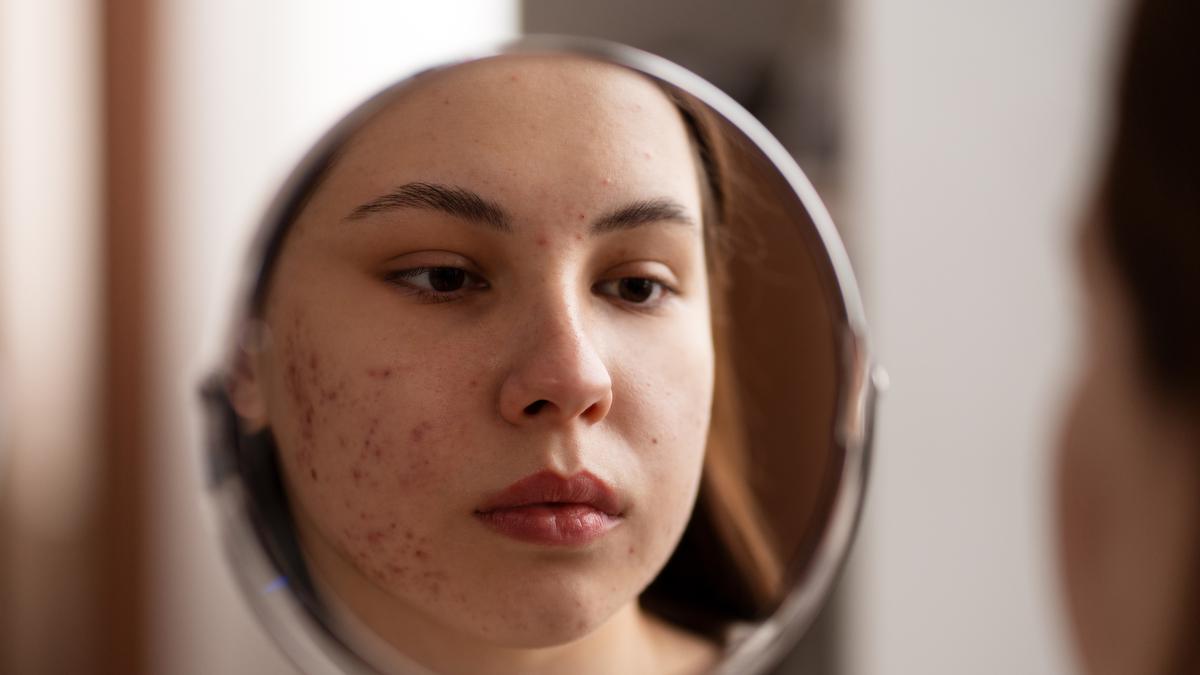 Cystic Acne Bikin Nggak Percaya Diri? Ini Penyebab dan Solusinya!