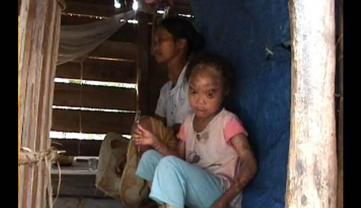 Amanah (10), bocah asal Mamuju, Sulawesi Barat, hidup tersisih karena kulitnya bersisik yang diduga akibat kelainan genetika. (Istimewa)