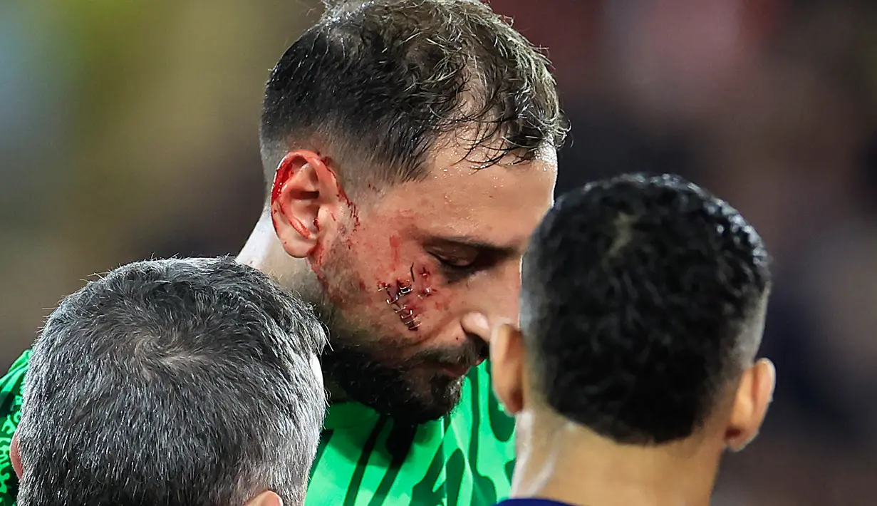 Benturan itu langsung menyebabkan luka sobek dalam yang mengakibatkan darah mengalir deras dari wajah kiper timnas Italia tersebut. Mantan pemain AC Milan tersebut harus mendapatkan 10 jahitan di wajahnya. (AFP/Valery Hache)