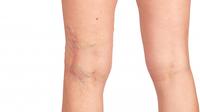 Ilustrasi Penyakit Varises Credit: pexels.com/pixabay