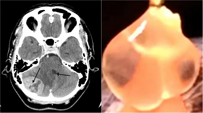 Hasil pemindaian CT pada otak pasien. Ternyata ada 8 kantung telur dalam otaknya. (Sumber Wikipedia dan cuplikan video Inside Edition)