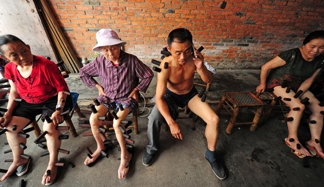 Sejumlah pasien menjalani terapi bekam tradisional di sebuah klinik di Pujiang County, Chengdu, Tiongkok (10/8). Terapi bekam telah menjadi salah satu pengobatan warisan leluhur bangsa Tiongkok. (REUTERS)