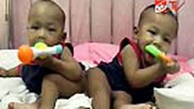 Sepasang bayi kembar siam di Jombang lahir dengan pinggul yang berdempetan. Keduanya hanya memiliki satu anus dan satu kelamin.
