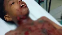 Seorang bocah menderita luka parah di leher dan dada setelah petasan yang akan ia lempar meledak di tangannya sendiri