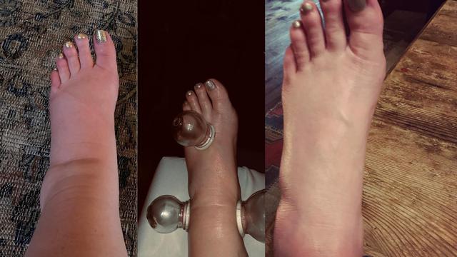Kaki Jessica Simpson sebelum dan setelah dibekam (Instagram/ jessicasimpson)