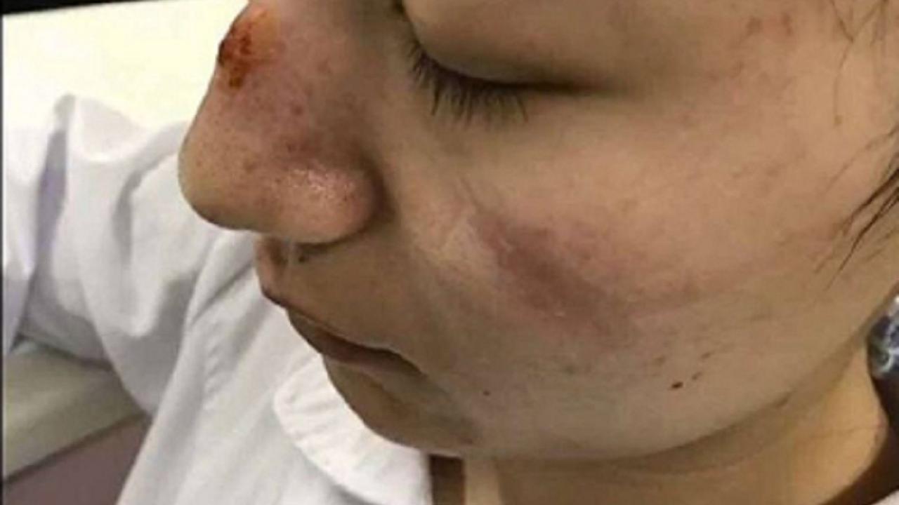 7 Potret Luka Lebam di Wajah Tim Medis Akibat Kacamata Pelindung Selama Perangi Virus Corona