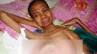 Nendah, Penderita Tumor di Payudara Seberat 5 kg